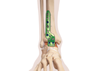 AFX - Analord5,6,8,9 4枚セット XBRAID よつあみ・YGK ロンフォート リアルデシテックス